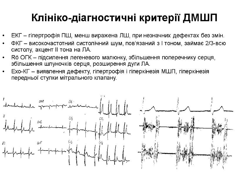 Клініко-діагностичні критерії ДМШП ЕКГ – гіпертрофія ПШ, менш виражена ЛШ, при незначних дефектах без